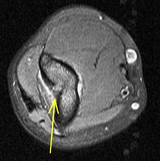Figure 5 for case Osteoid Osteoma